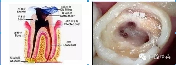 根管治療中開(kāi)放的危害