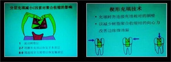 各類牙洞型樹(shù)脂修復(fù)
