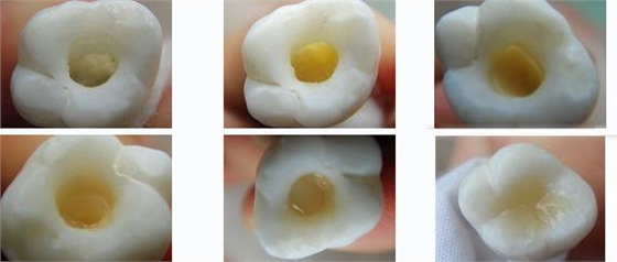 各類牙洞型樹(shù)脂修復(fù)