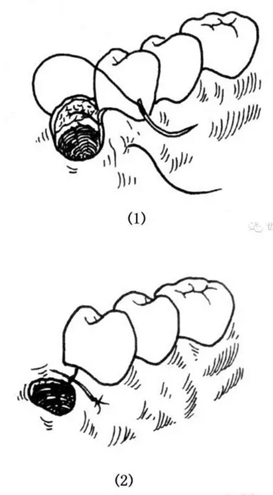 牙醫(yī)基本技能：口內(nèi)縫合術(shù)（文字、示意圖及視頻）