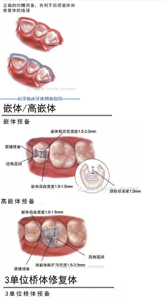 時(shí)常搞不清楚怎么備牙嗎？義獲嘉教您如何完美備牙