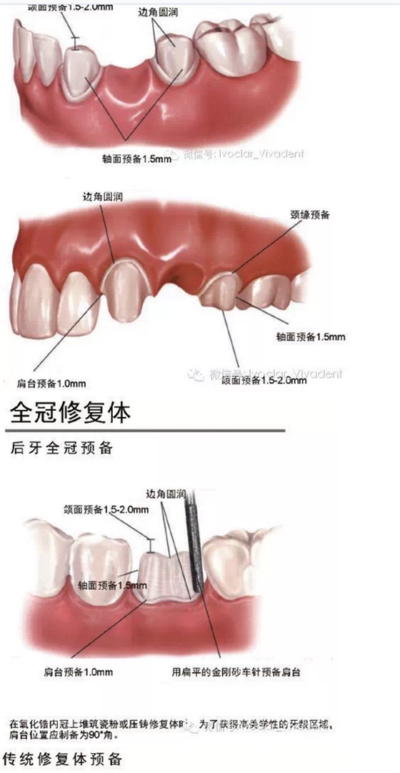 時(shí)常搞不清楚怎么備牙嗎？義獲嘉教您如何完美備牙