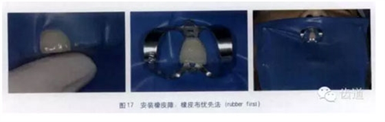 橡皮障的臨床運(yùn)用大全 橡皮障的臨床運(yùn)用大全