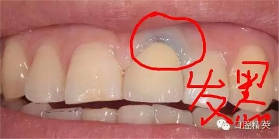為什么牙醫(yī)叫您做二氧化鋯