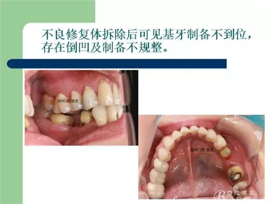 左下后牙不良修復體拆除后重新修復一例