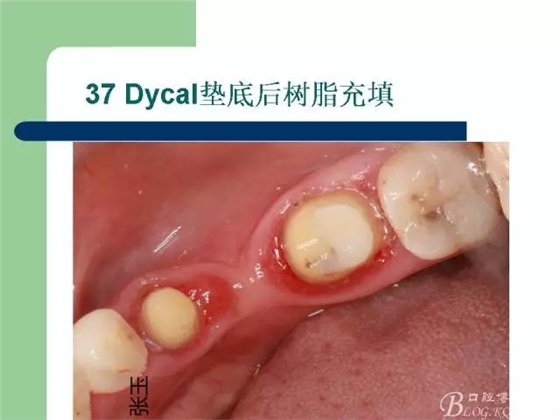 左下后牙不良修復體拆除后重新修復一例