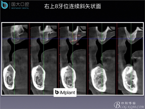 上頜竇底區(qū)域嚴(yán)重骨吸收的臨床種植案例.jpeg