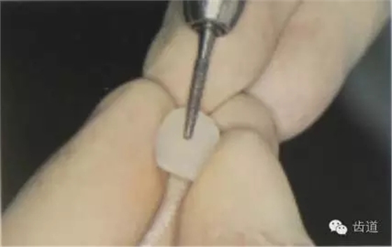 瓷貼面的粘接步驟及技術(shù)要點(diǎn)