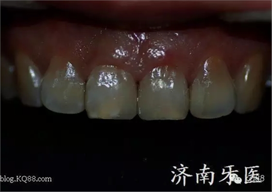 四環(huán)素牙修復(fù)真實(shí)操作.png