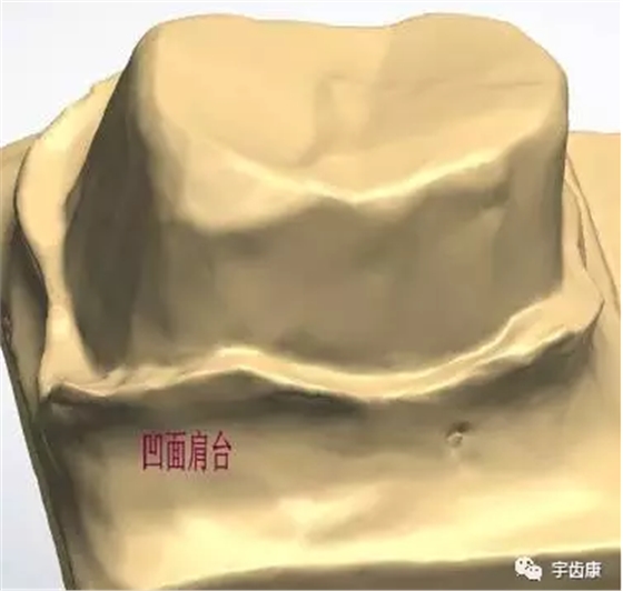 影響全瓷牙冠裂的因素有哪些？