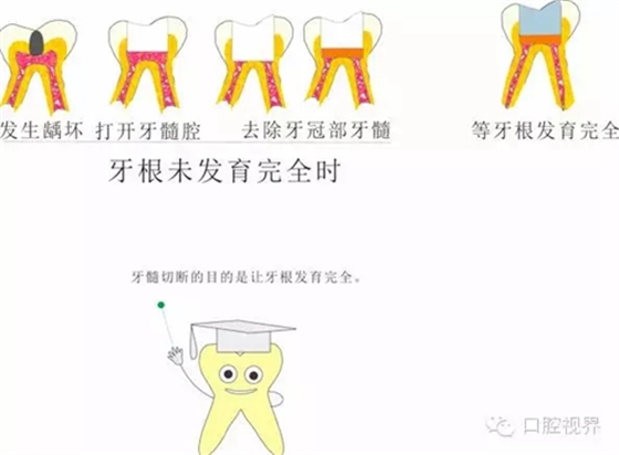 【愛牙科普知識(shí)300問】 “什么是活髓切斷術(shù)？”