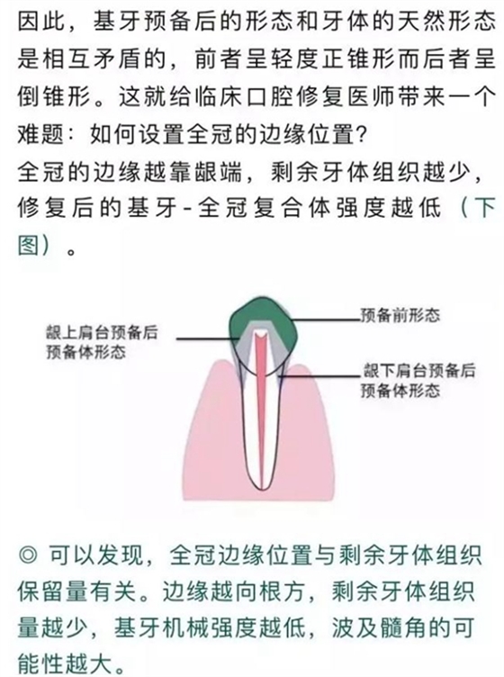 做全冠修復時基牙根面暴露，如何備牙？