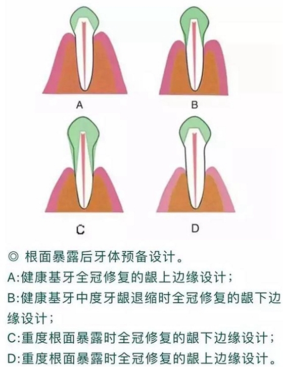 做全冠修復時基牙根面暴露，如何備牙？