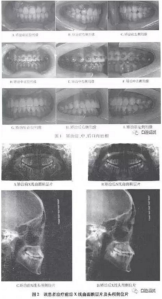 尖牙完全唇側(cè)錯(cuò)位擁擠，矯正1例  
