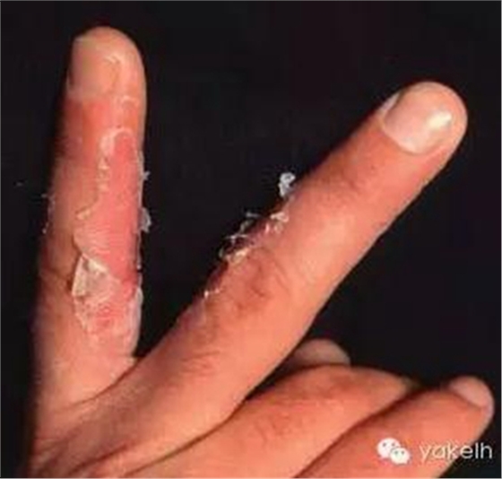 正畸中與材料相關(guān)的副作用---樹脂基材料的過敏反應(yīng)