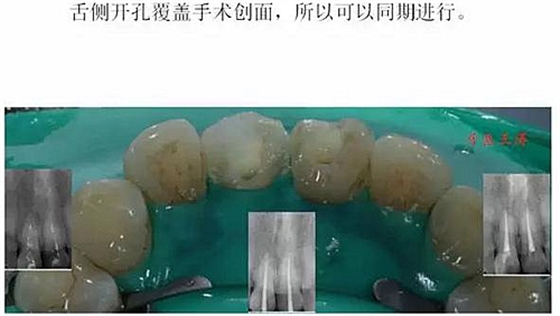 前牙外傷冠延長+全瓷冠修復(fù)