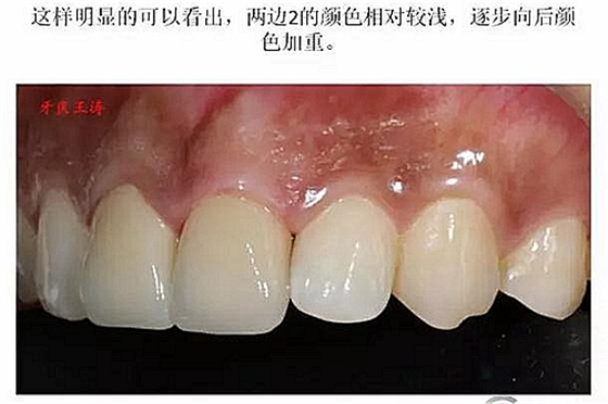 前牙外傷冠延長+全瓷冠修復(fù)