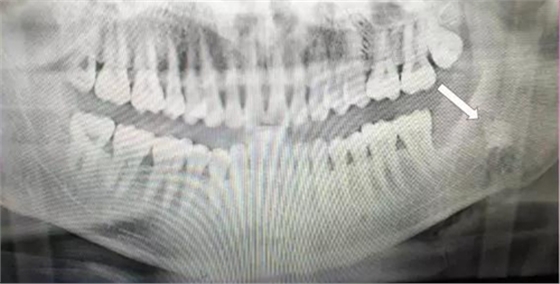 拔牙斷根的去與留？