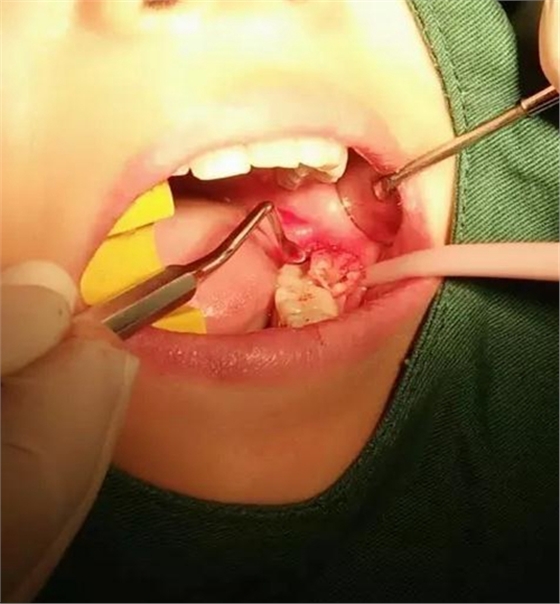 拔牙斷根的去與留？