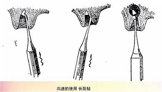 拔牙斷根的去與留？