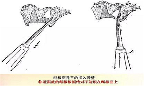 拔牙斷根的去與留？