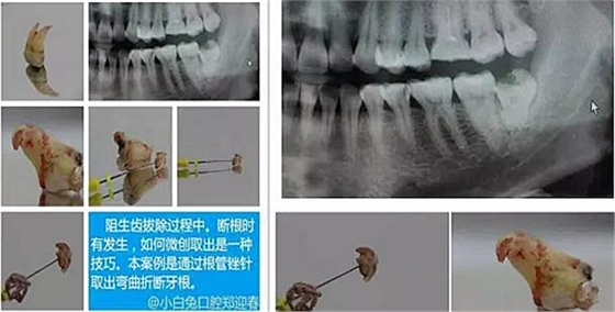 拔牙斷根的去與留？