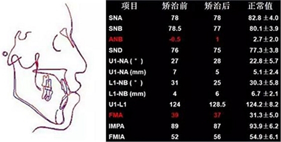 種植釘多維運用矯正高角反頜及開頜—對羅晨醫(yī)生專訪及病例展示（上）