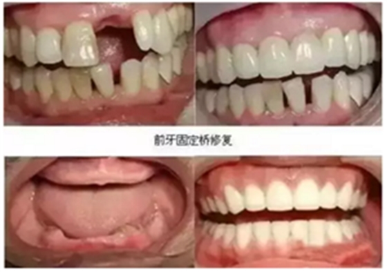 一位資深牙醫(yī)的總結(jié) | 如何減輕患者鑲牙后酸痛癥狀的措施！