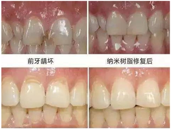 【收藏】關(guān)于補牙，知道這些就夠了！