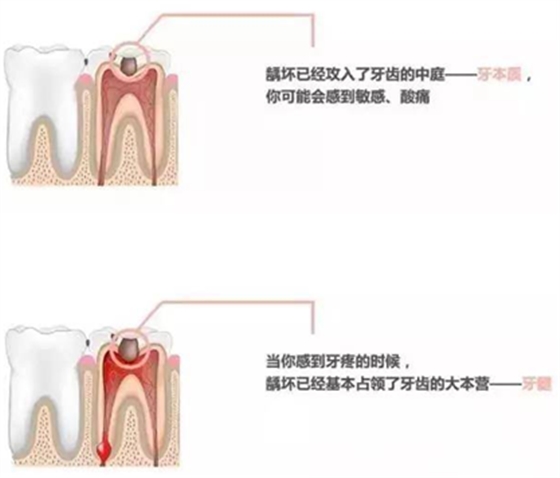 【收藏】關(guān)于補牙，知道這些就夠了！