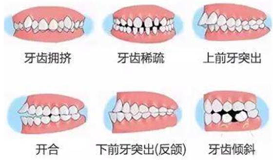 關(guān)于牙齒矯正，你想知道的都在這！