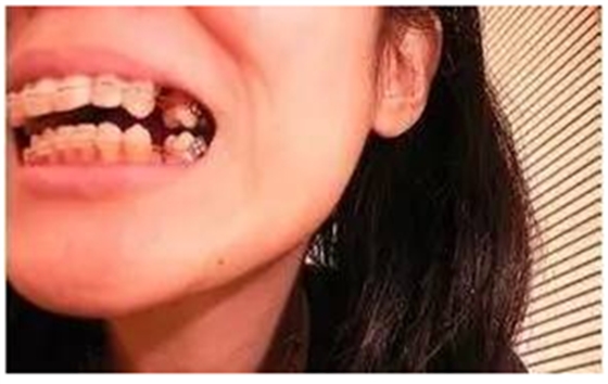 關(guān)于牙齒矯正，你想知道的都在這！