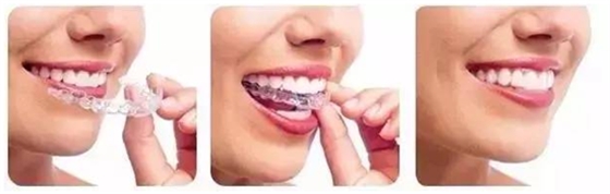 關(guān)于牙齒矯正，你想知道的都在這！