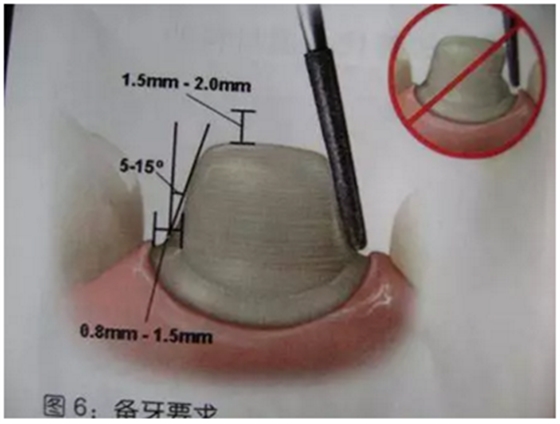 醫(yī)生，我的烤瓷牙上有個黑線怎么回事？