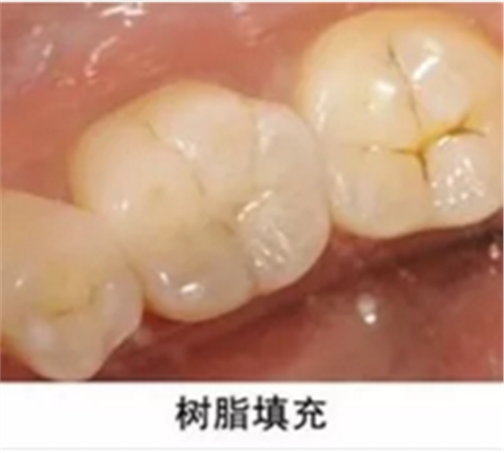 完全不懂，各種補(bǔ)牙材料，到底怎么選？