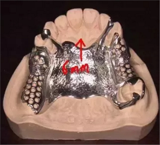 活動(dòng)義齒修復(fù)，要懂的鋼托設(shè)計(jì)