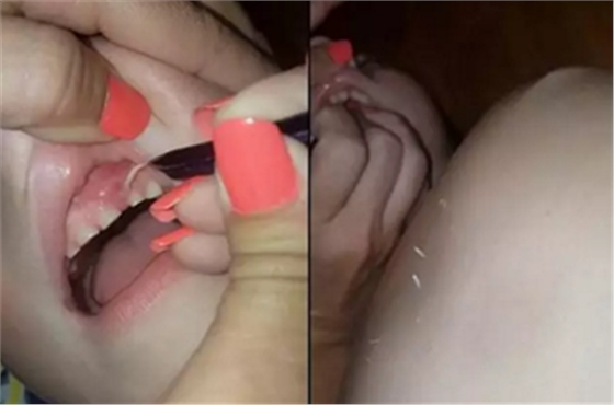 牙齦里拔出27片斷甲，是一種怎樣的體驗？