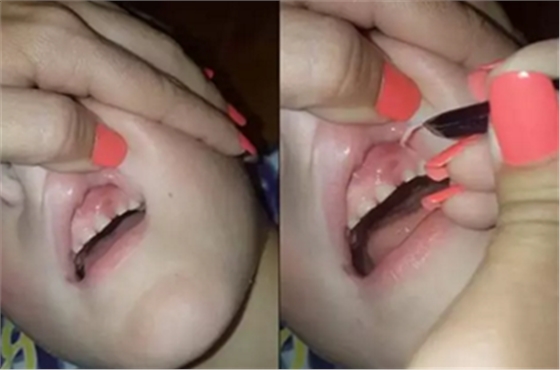 牙齦里拔出27片斷甲，是一種怎樣的體驗？