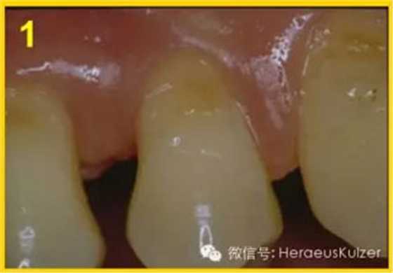 簡單治療——格魯瑪脫敏劑的應(yīng)用