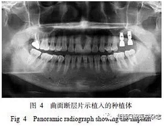 利用壓膜式活動矯治器壓入下頜第一、第二磨牙1例