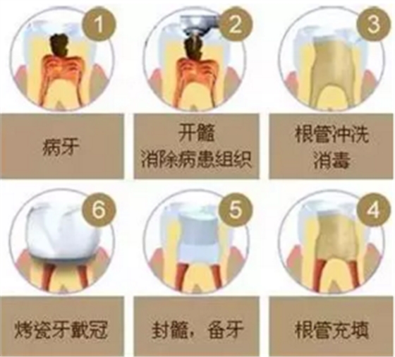 醫(yī)生，牙齒折斷不是應(yīng)該補上去嗎，為啥要做根管治療？