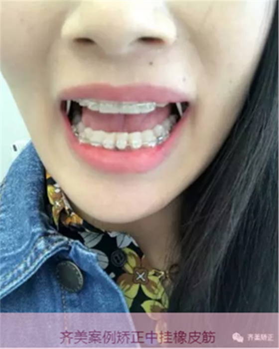 牙齒矯正，為什么要掛橡皮筋？
