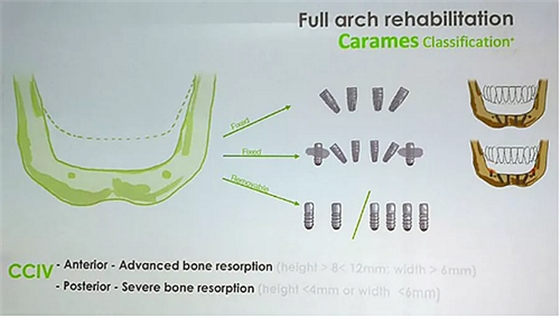 【熱點回顧】帶您深度了解無牙頜種植修復(fù)——Pro Arch