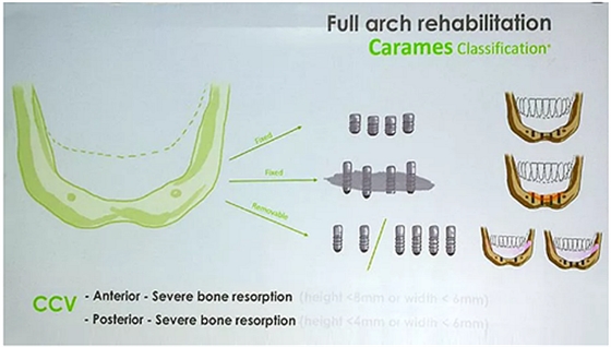【熱點回顧】帶您深度了解無牙頜種植修復(fù)——Pro Arch