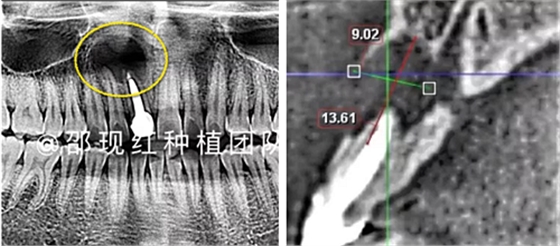 「科普篇」你真的了解它嗎？——β-磷酸三鈣