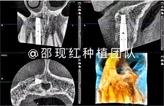 「科普篇」你真的了解它嗎？——β-磷酸三鈣