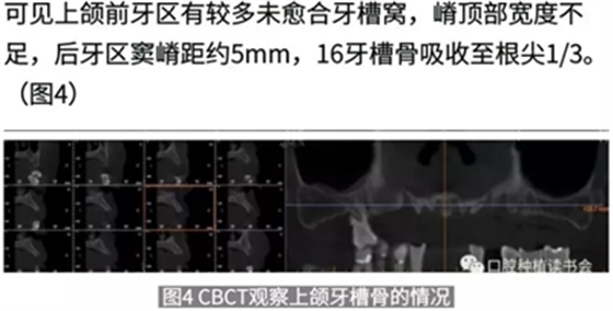病例報(bào)道│全程數(shù)字化輔助無(wú)牙頜種植即刻負(fù)重