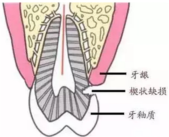 今天開(kāi)始不要再這樣刷牙了，你的牙齒快被刷掉了！