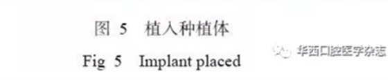 下頜骨腓骨移植聯(lián)合牙種植術后的覆蓋義齒修復1例