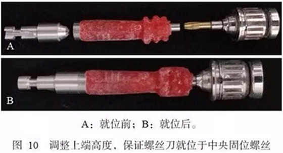 下頜骨腓骨移植聯(lián)合牙種植術后的覆蓋義齒修復1例